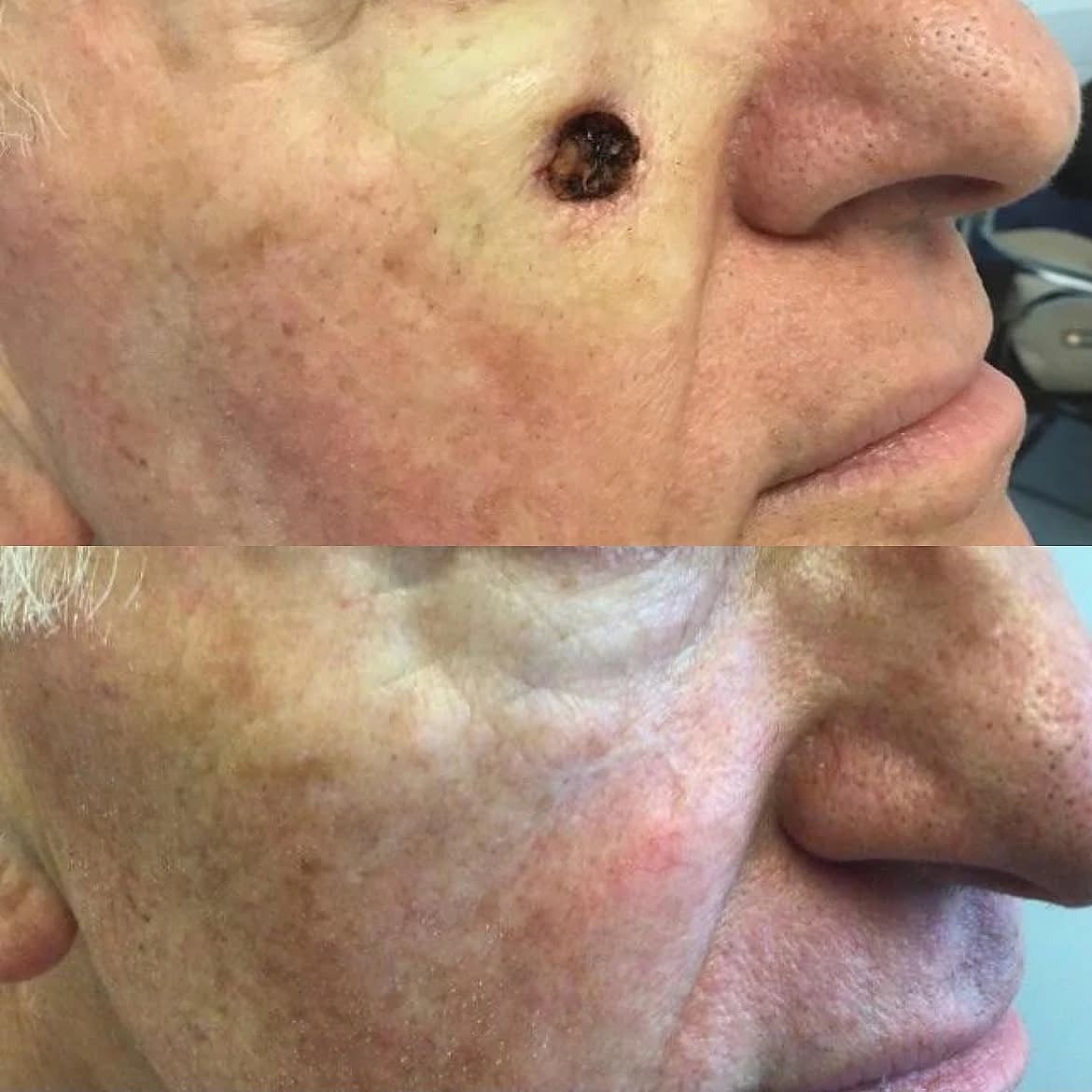 Facial post-Mohs surgical site before reconstruction and healed result after reconstruction