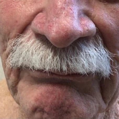 Nose three months after Mohs surgery and same-day reconstruction for basal cell carcinoma