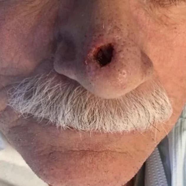 Open nasal surgical site after basal cell carcinoma removal with Mohs surgery and before reconstruction