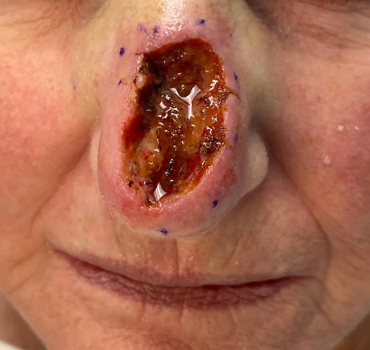 Open nasal surgical site after basal cell carcinoma removal with Mohs surgery and before reconstruction