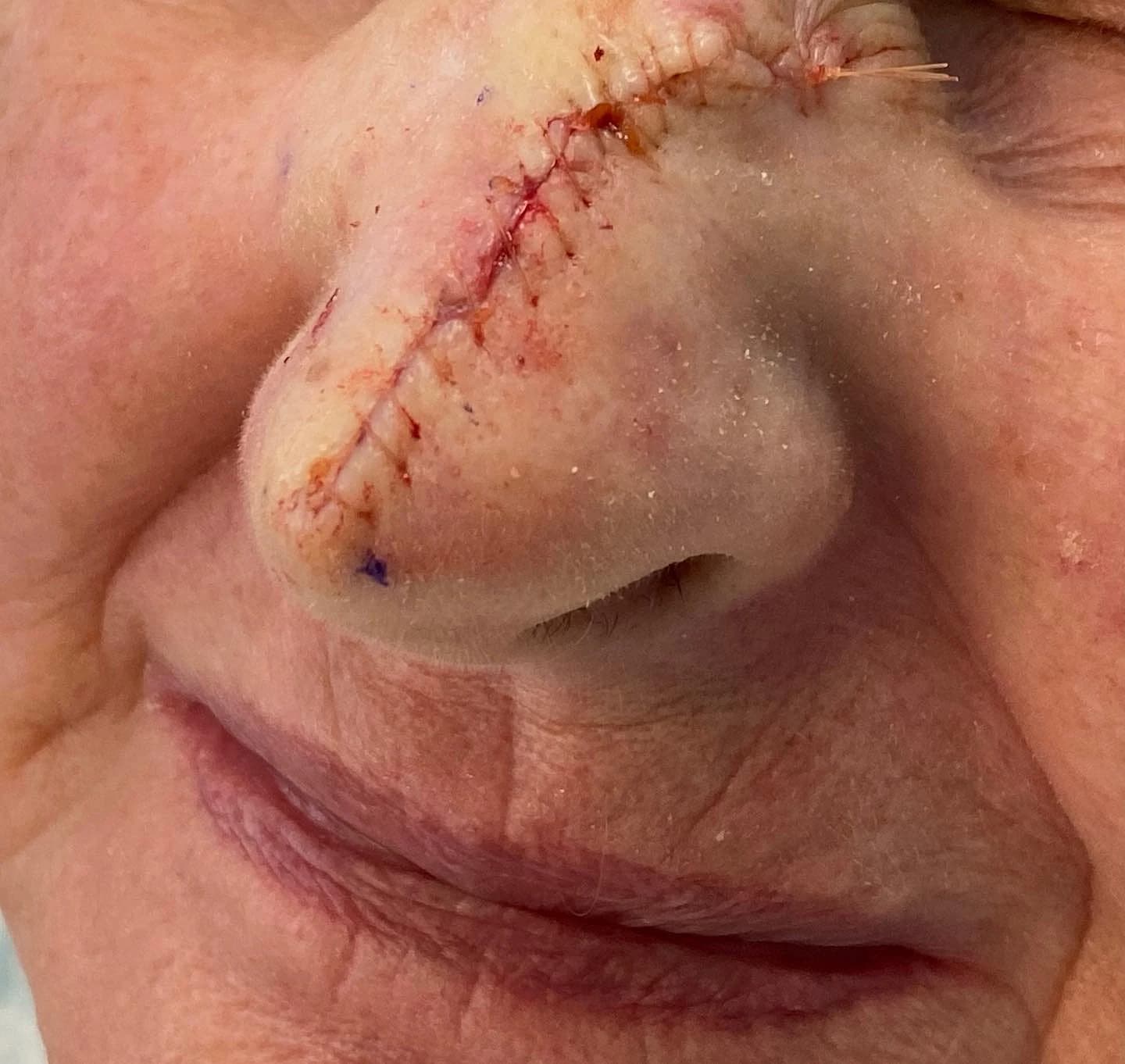 Nose immediately after reconstruction following Mohs surgery for basal cell carcinoma