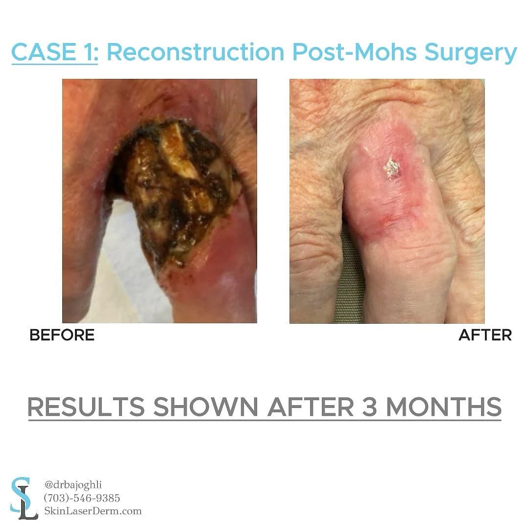 Hand before reconstruction and three months after a full-thickness skin graft following Mohs surgery