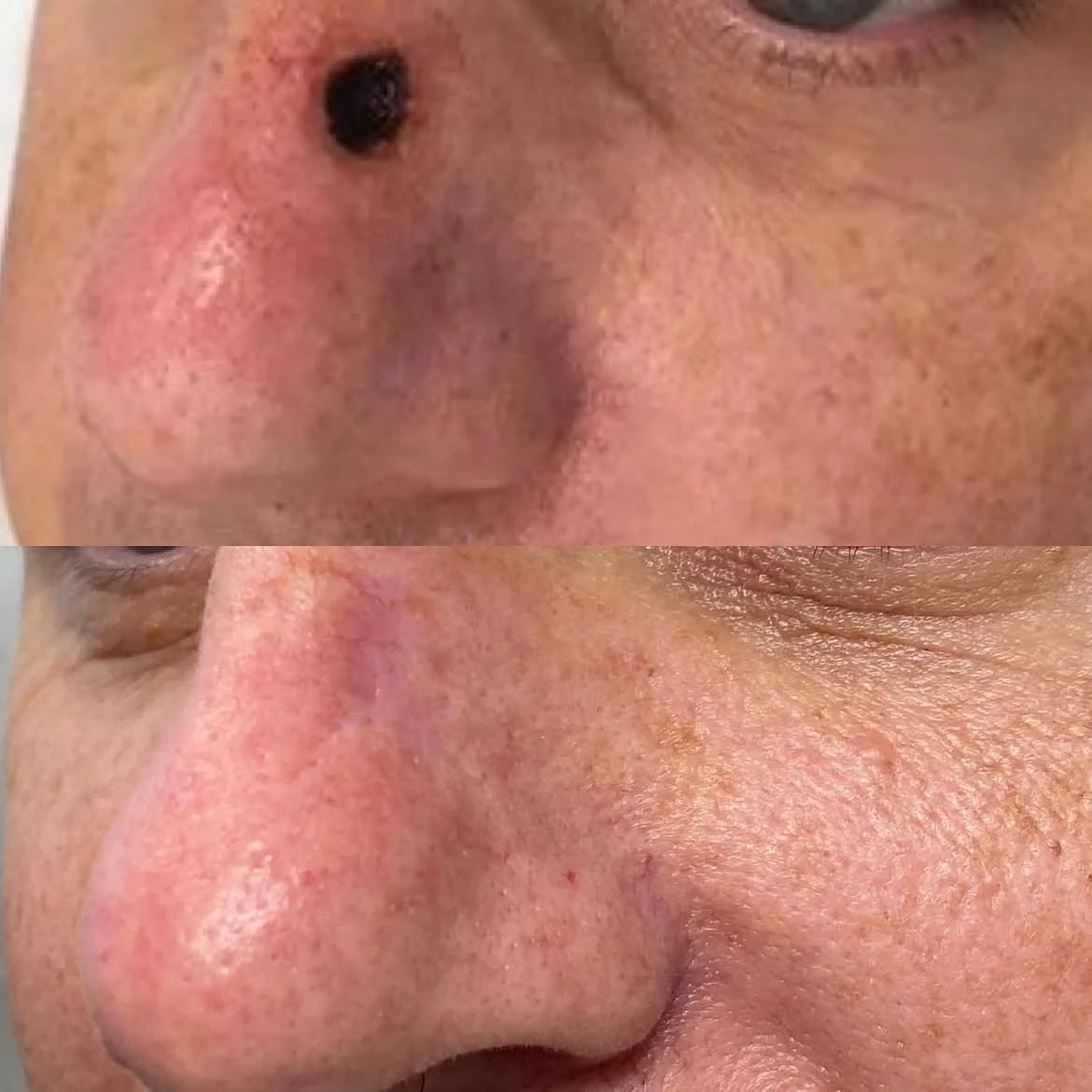 Squamous cell carcinoma on the nose before Mohs surgery and healed nasal skin one year after treatment