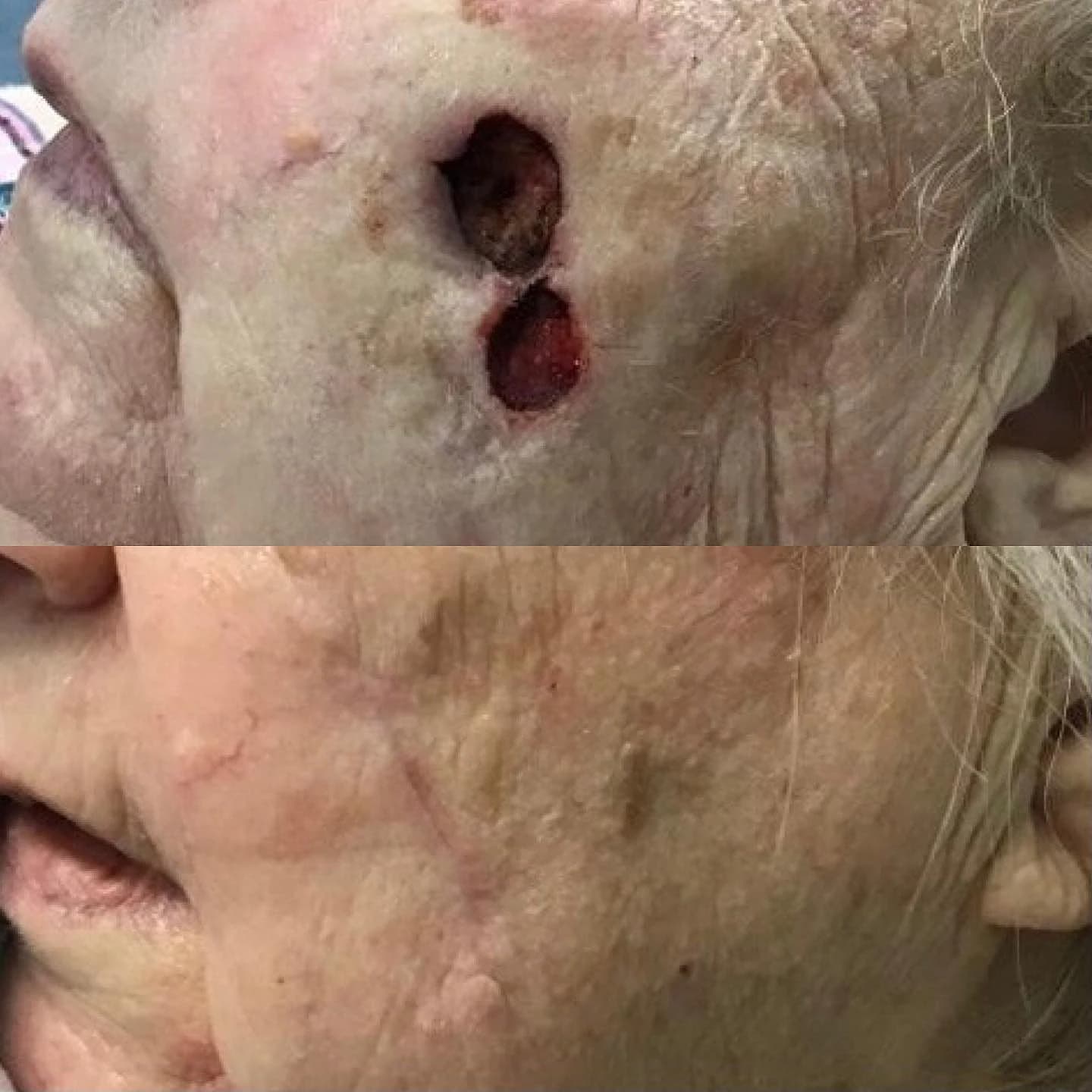 Two open cheek surgical sites after Mohs surgery and healed cheek five months after reconstruction