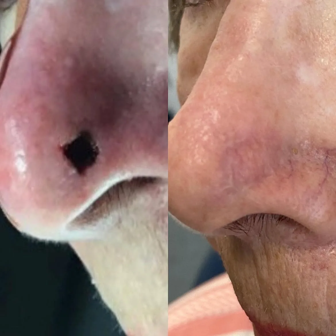 Post-Mohs surgical site on the nose before cosmetic repair and healed result after reconstruction