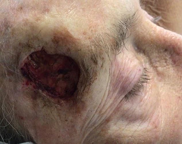 Open temple surgical site after basal cell carcinoma removal with Mohs surgery and before reconstruction