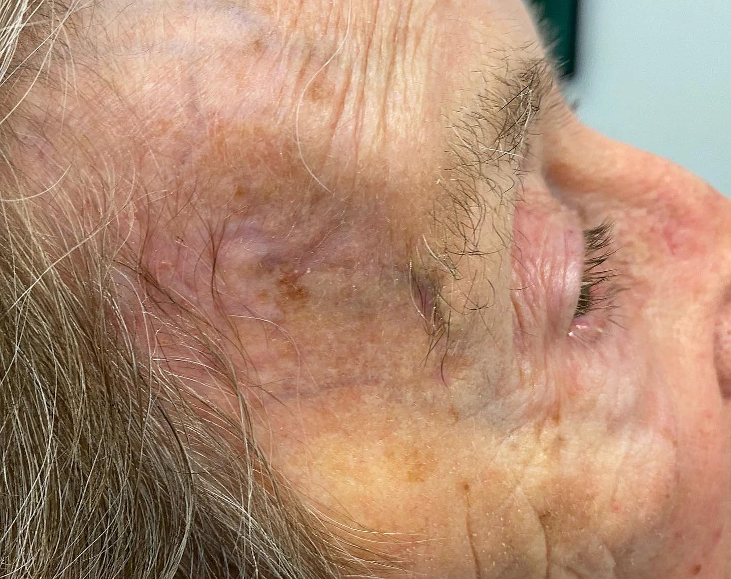 Temple after reconstruction following Mohs surgery for basal cell carcinoma