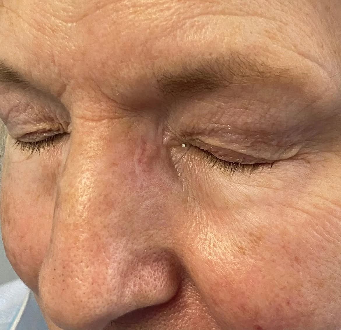 Nose after repair following basal cell carcinoma removal with Mohs surgery