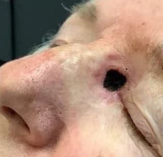 Open surgical site on the nose after basal cell carcinoma removal with Mohs surgery and before reconstruction
