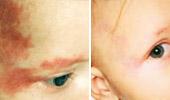 Birthmark Removal