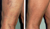 Leg Vein Treatment (Sclerotherapy)