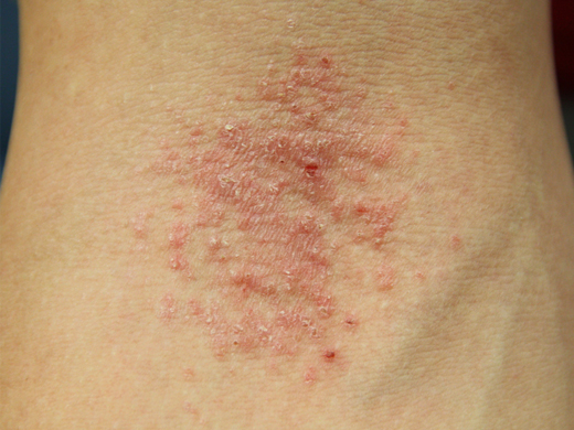 eczema