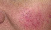 Rosacea