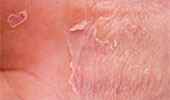 Eczema/Atopic Dermatitis