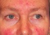 Picture of Rosacea