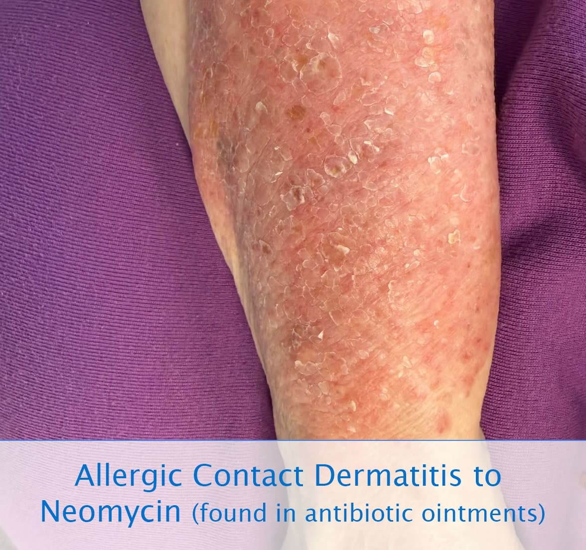Allergic contact dermatitis caused by neomycin in an antibiotic ointment