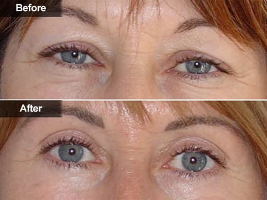 Blepharoplasty Eyelid Surgery clinical photo