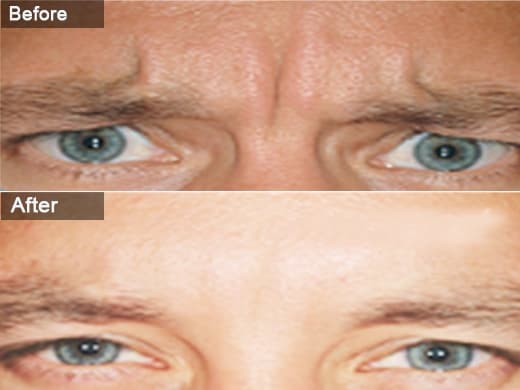 Dysport clinical photo