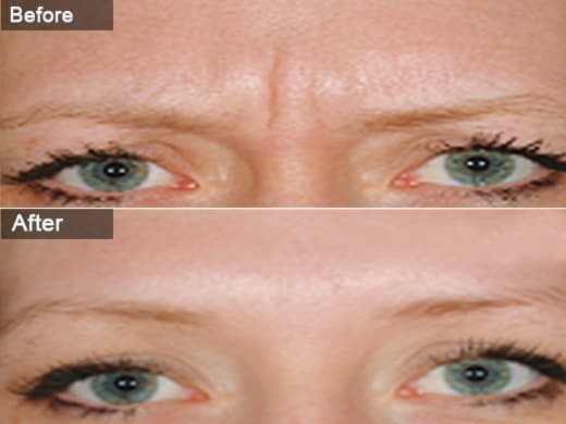 Dysport clinical photo
