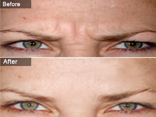 Dysport clinical photo