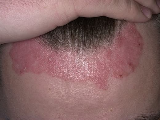 Psoriasis clinical photo