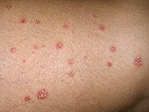 Psoriasis clinical photo