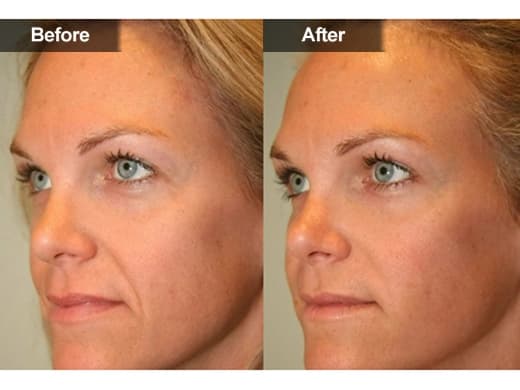 Radiesse® clinical photo