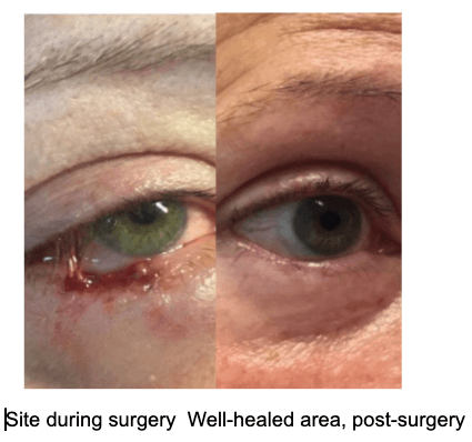 Basal cell carcinoma on or around the eye