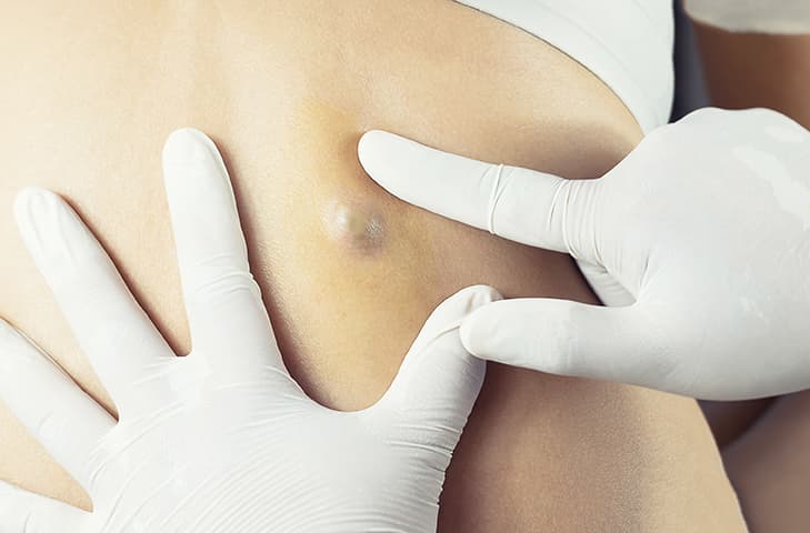 cyst