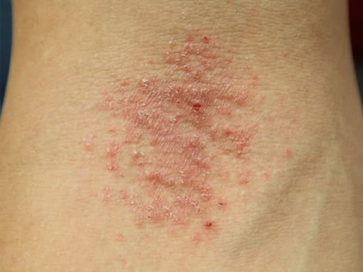 Eczema-Atopic-Dermatitis-010