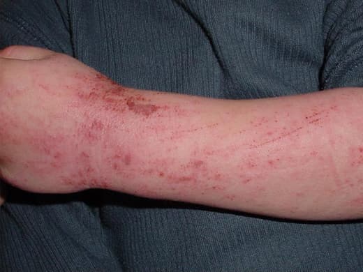 Eczema-Atopic-Dermatitis-020