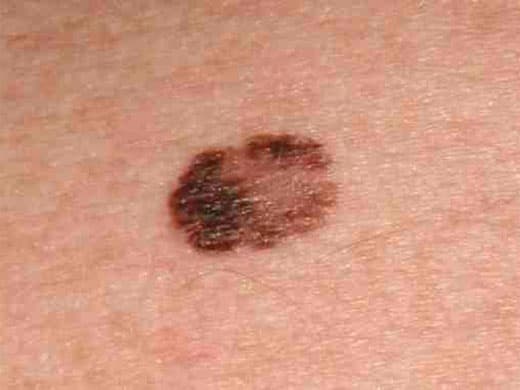 Moles, Atypical Moles & Melanoma clinical photo