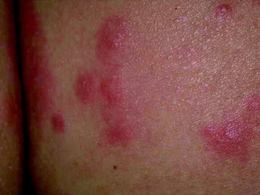 Rashes clinical photo