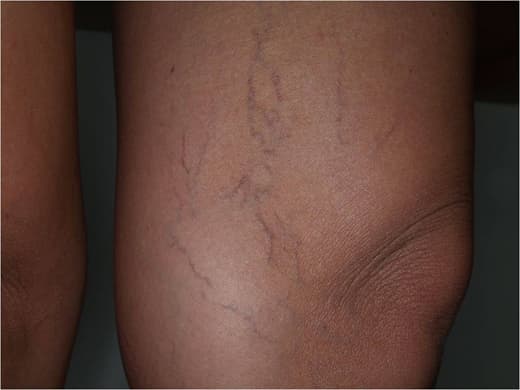 Spider Veins clinical photo