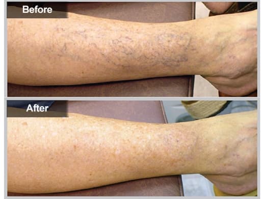 Spider Veins clinical photo