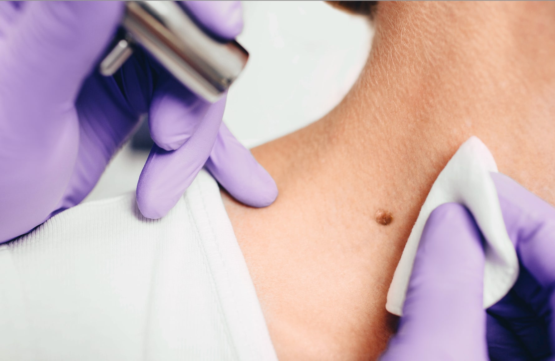 Dermatology clinician examining a mole with a dermatoscope
