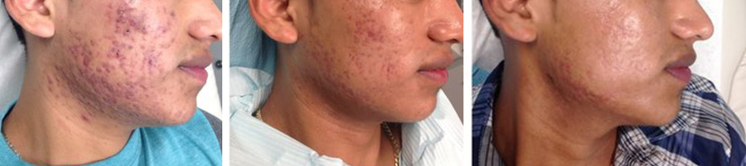 Acne Scarring Treatment