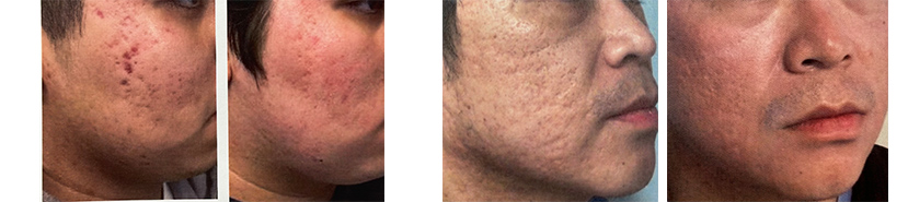 acne scarring dermatology2
