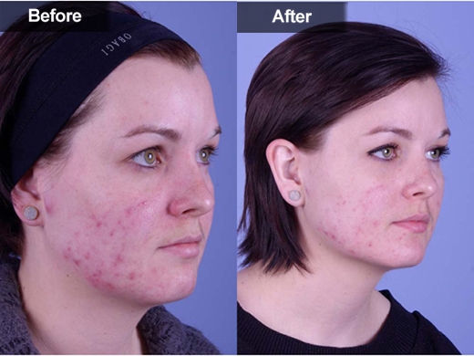 Acne Treatments clinical photo