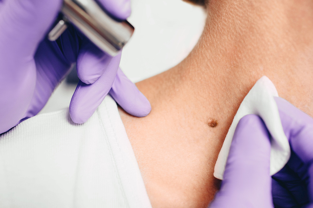 Benign Moles and Mole Removal | DPN