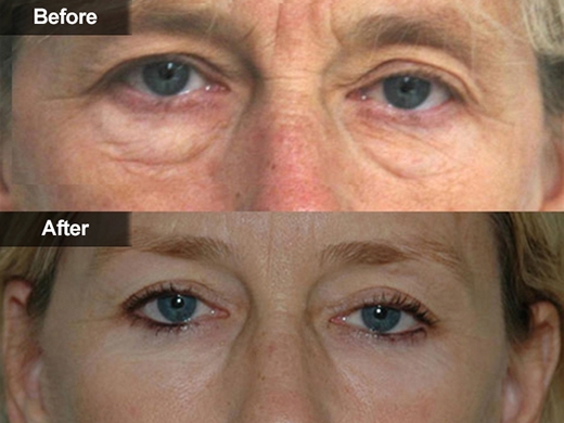 Blepharoplasty Eyelid Surgery clinical photo