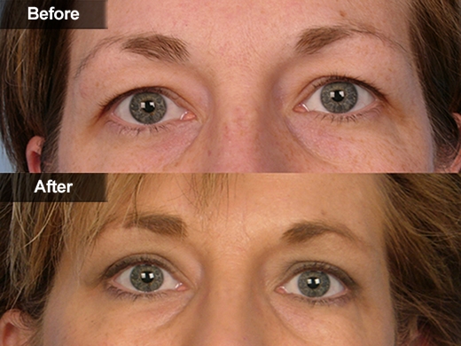 Blepharoplasty Eyelid Surgery clinical photo