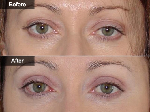 Blepharoplasty Eyelid Surgery clinical photo