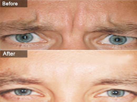 Dysport clinical photo