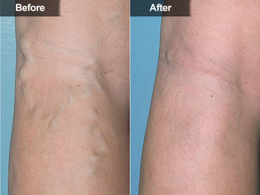 Sclerotherapy (Leg Vein Treatment) clinical photo