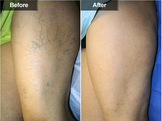 Sclerotherapy (Leg Vein Treatment) clinical photo