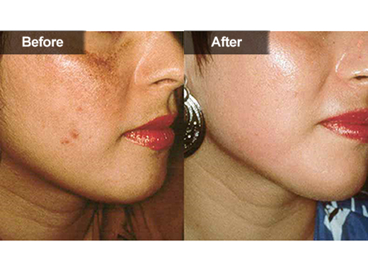 Microdermabrasion / Power Peels® clinical photo