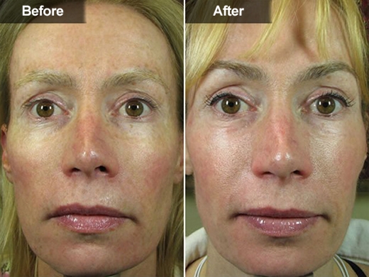 Microdermabrasion / Power Peels® clinical photo