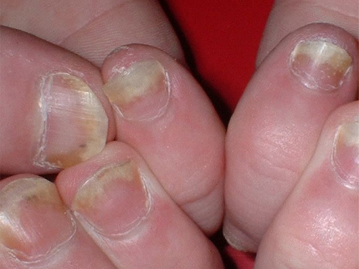 Psoriasis clinical photo
