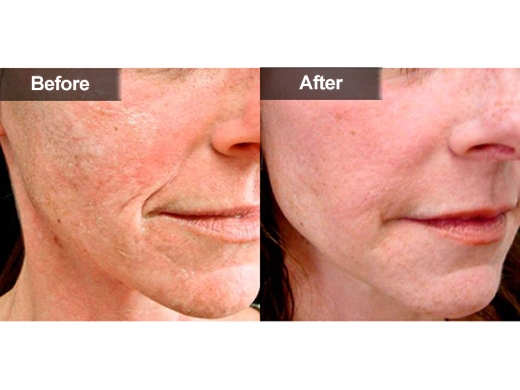 Radiesse® clinical photo